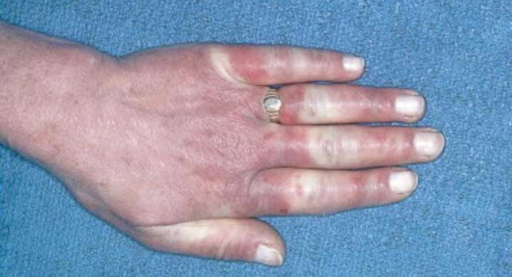 Klinický obraz Raynaudova syndromu - vazospasmus, hyperémie, edém